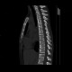 Osteopathia striata, systemic bone disorder: CT - Computed tomography
